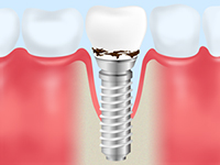 インプラント歯周炎とは(2)